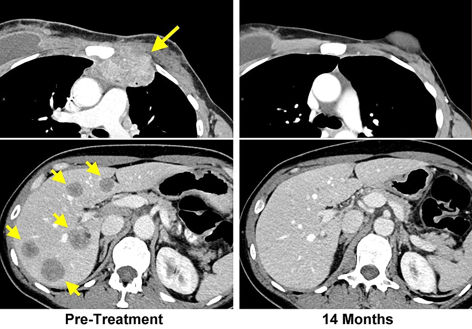 Left: MRI scans of a woman with breast cancer before TIL therapy show a lesion invading the chest wall (top) and metastatic lesions in the liver (bottom). Right: Scans 14 months after treatment show all lesions have disappeared.
A novel approach to immunotherapy developed by researchers at the Natio